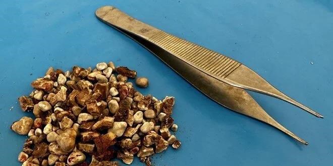 Böbreğinden 300'ün üzerinde taş çıktı: 'Hatırası var' deyip eve götürdü